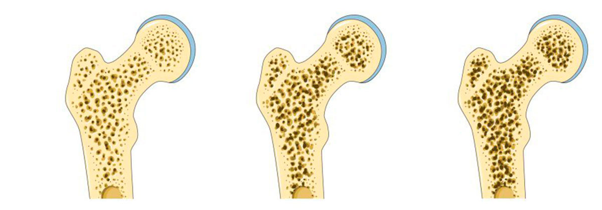 osteoporosi frattura femore