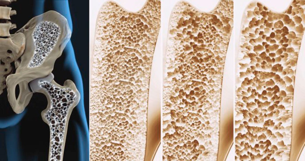 osteoporosi ossa fragili fratture